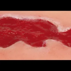 Modèle d'un ulcère veineux de la jambe en phase de granulation