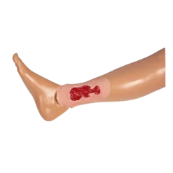 Modèle d'un ulcère veineux de la jambe en phase de granulation