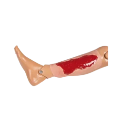 Modèle d'un ulcère veineux de la jambe en phase de granulation