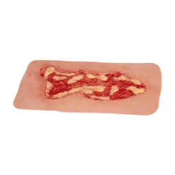 Modèle d'un ulcère veineux de la jambe en phase d'exsudation