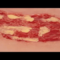 Modèle d'un ulcère veineux de la jambe en phase d'exsudation
