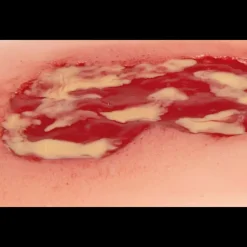 Modèle d'un ulcère veineux de la jambe en phase d'exsudation