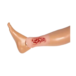 Modèle d'un ulcère veineux de la jambe en phase d'exsudation