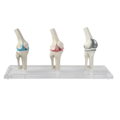 Modèles du genou Erler Zimmer (sain, malade, et avec implant)