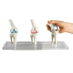 Modèles du genou Erler Zimmer (sain, malade, et avec implant)
