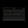 Pack promo ECG Spengler Cardiomate 3 (3 pistes) avec interprétation