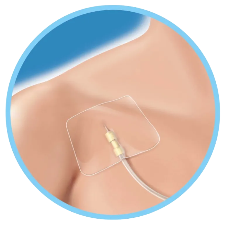 Pansement adhésif Securifix Plus pour cathéter (boite de 50)