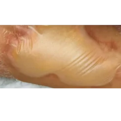 Pansements hydrocolloïdes morpho-adaptés Hartmann Hydrocoll