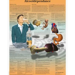 Planche anatomique 3B Scientific - Alcooldépendance VR2792
