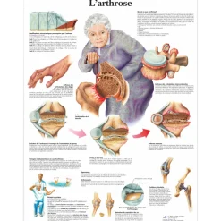 Planche anatomique 3B Scientific - L'arthrose VR2123