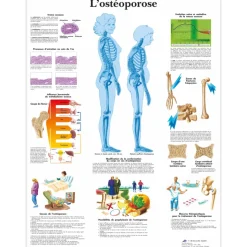 Planche anatomique 3B Scientific - L'ostéoporose VR2121