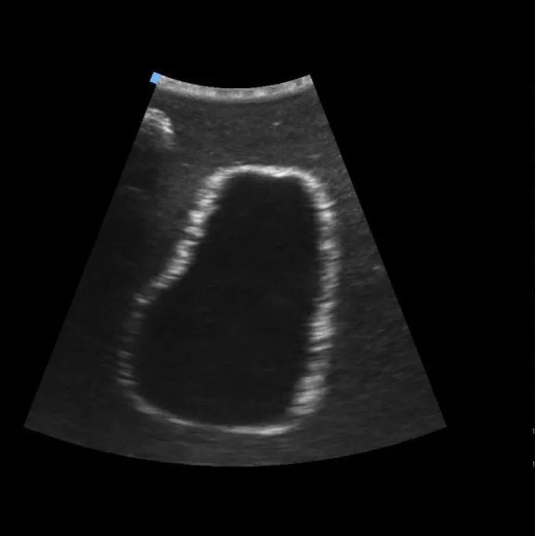 Simulateur d'échographie de vessie Erler Zimmer SonoEz